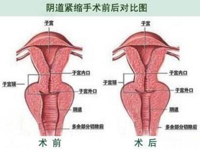 阴道紧缩术前术后对比图